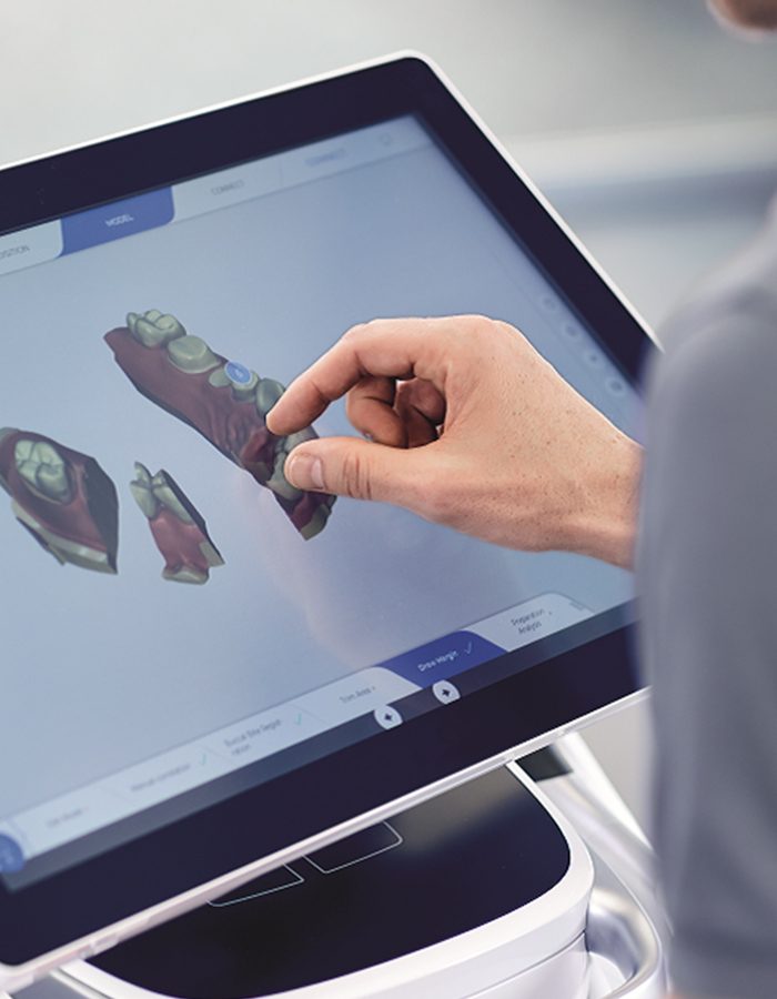 Cerec kronen